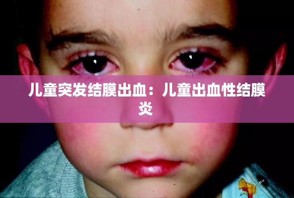 儿童突发结膜出血：儿童出血性结膜炎 