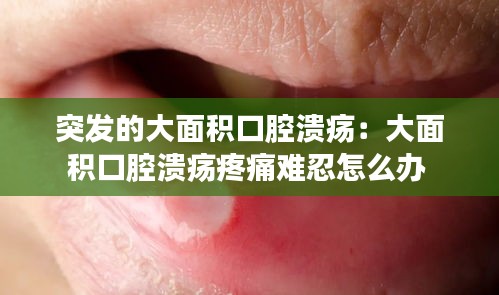 突发的大面积口腔溃疡：大面积口腔溃疡疼痛难忍怎么办 