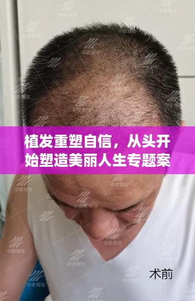 植发重塑自信，从头开始塑造美丽人生专题案例分享