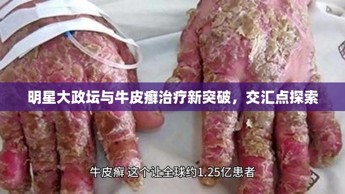 明星大政坛与牛皮癣治疗新突破,交汇点探索